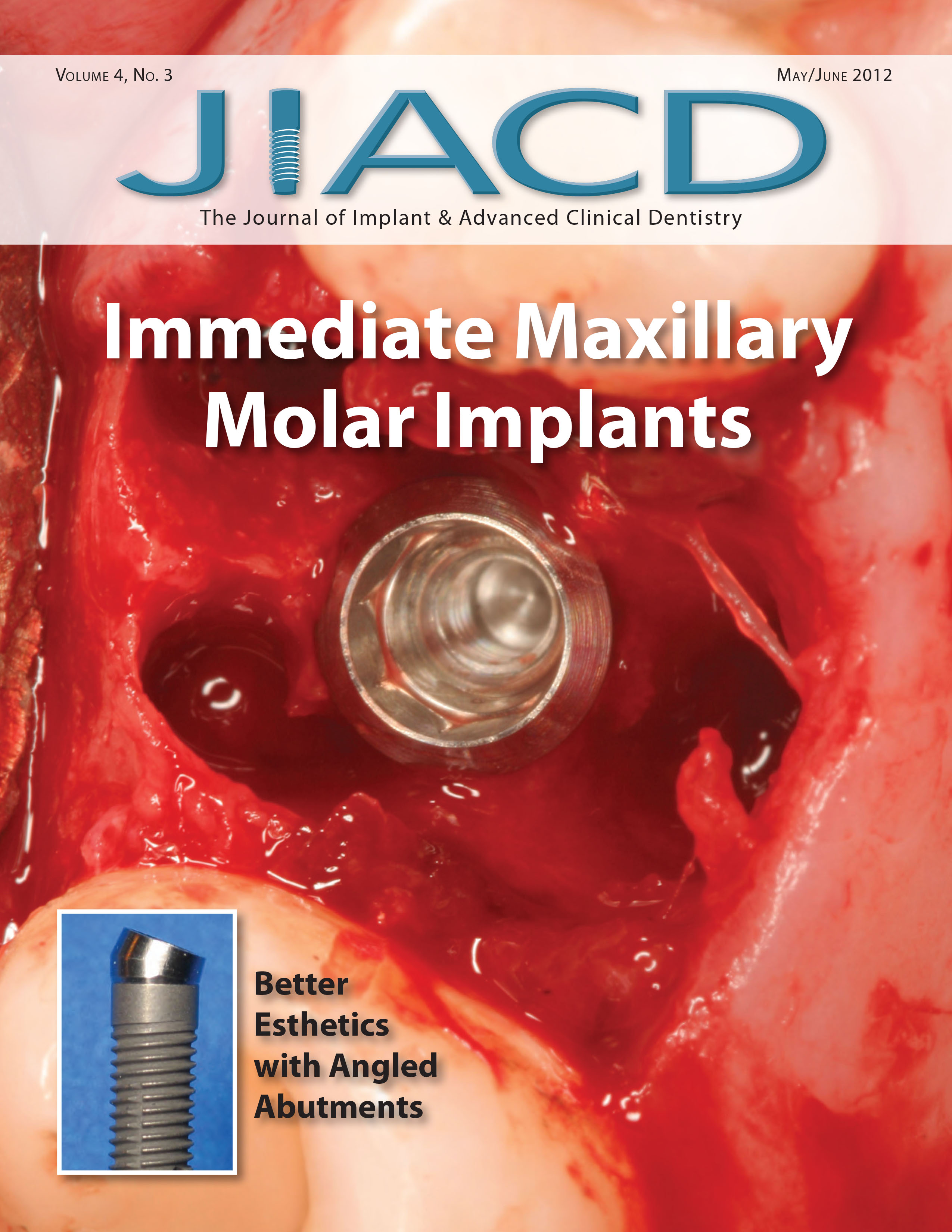 Immediate Maxillary Molar Implants