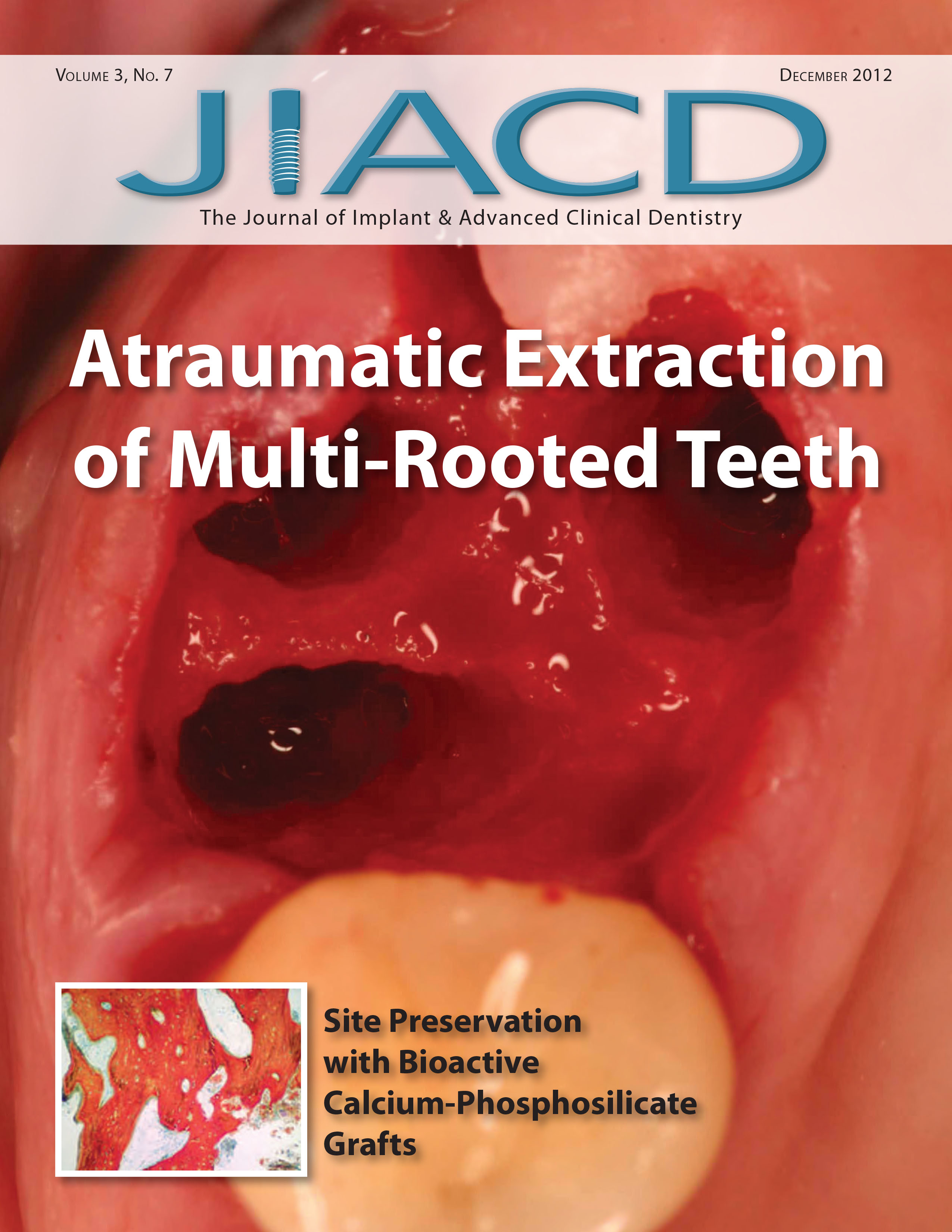 Atraumatic Extraction of Multi-Rooted Teeth Site Preservation
