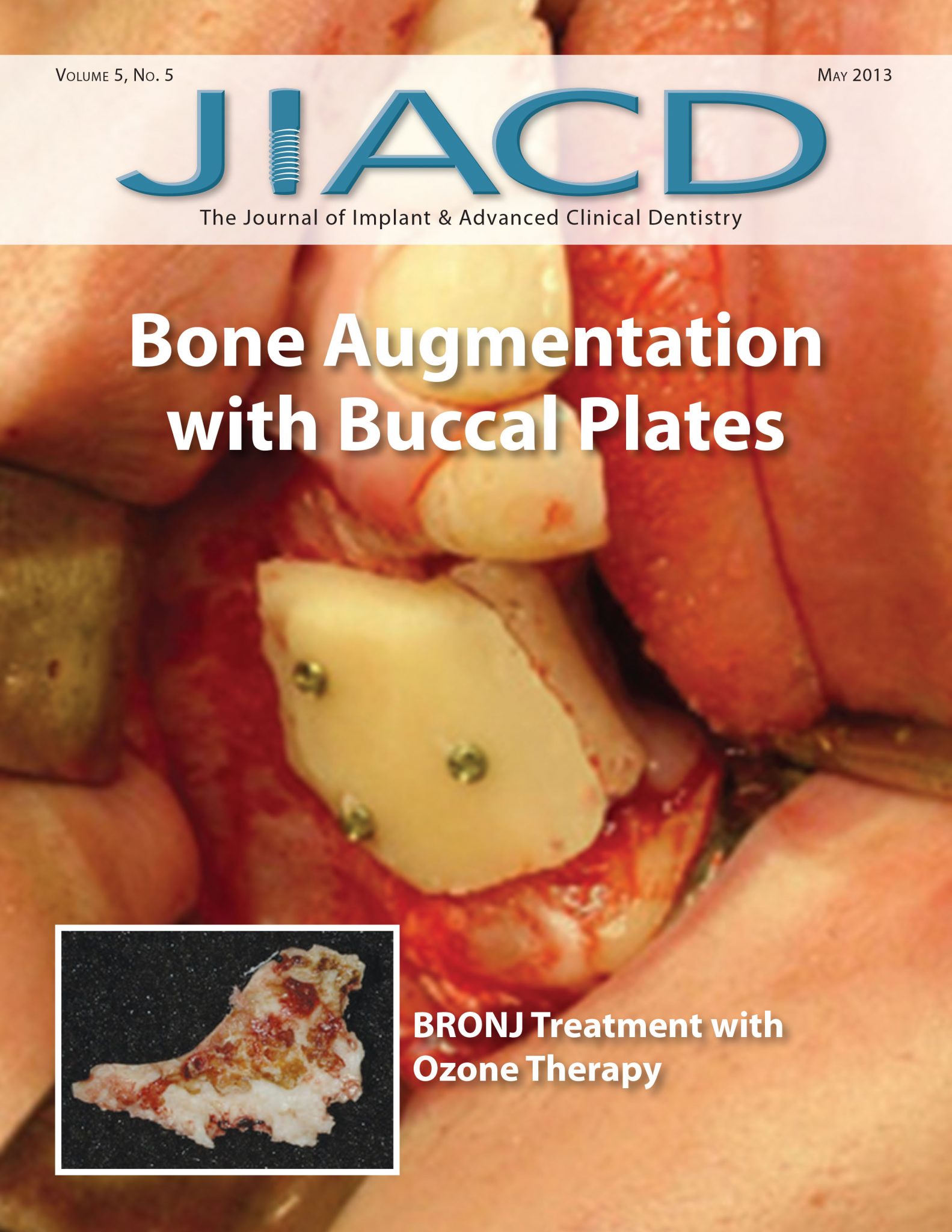 Bone Augmentation with Buccal Plates