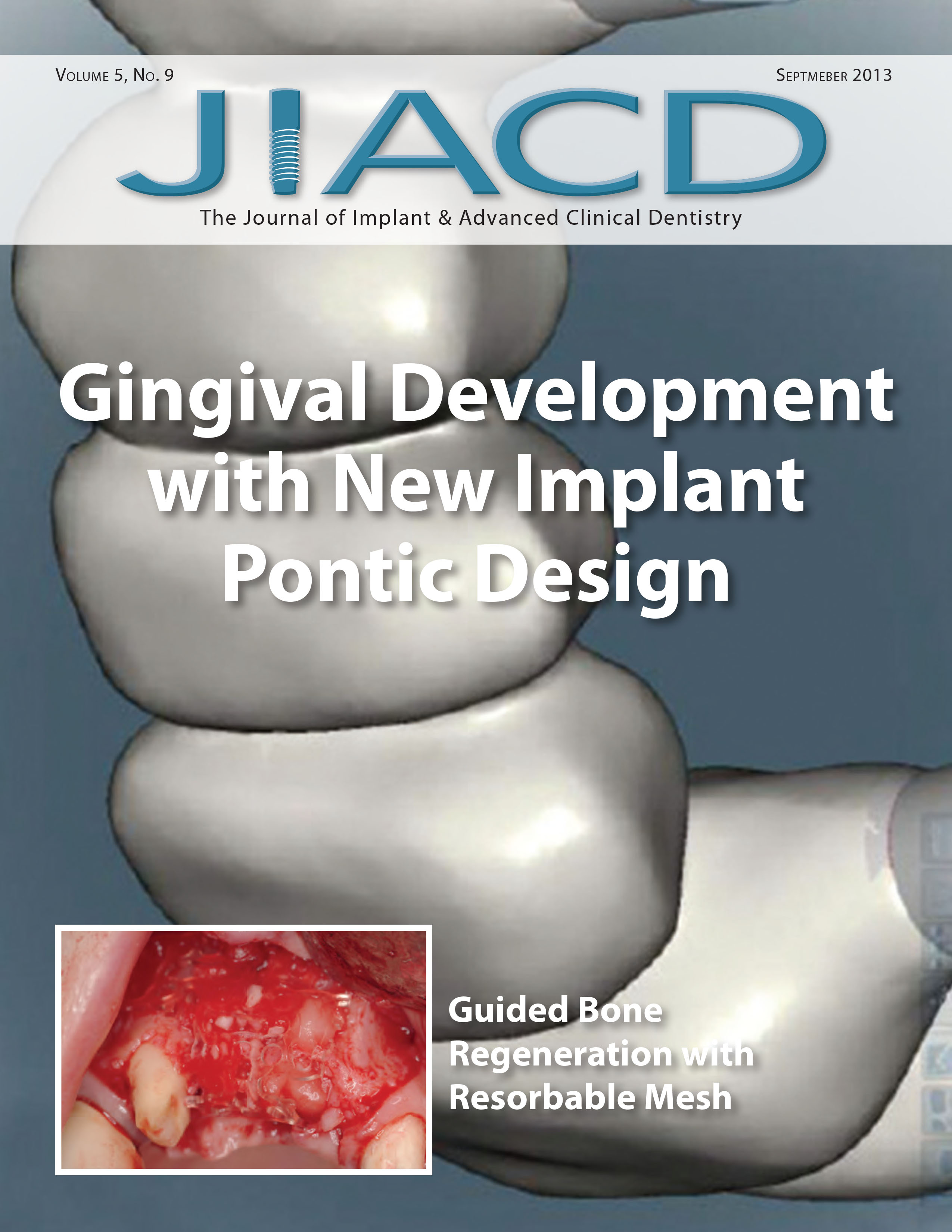 Gingival Development with New Implant Pontic Design