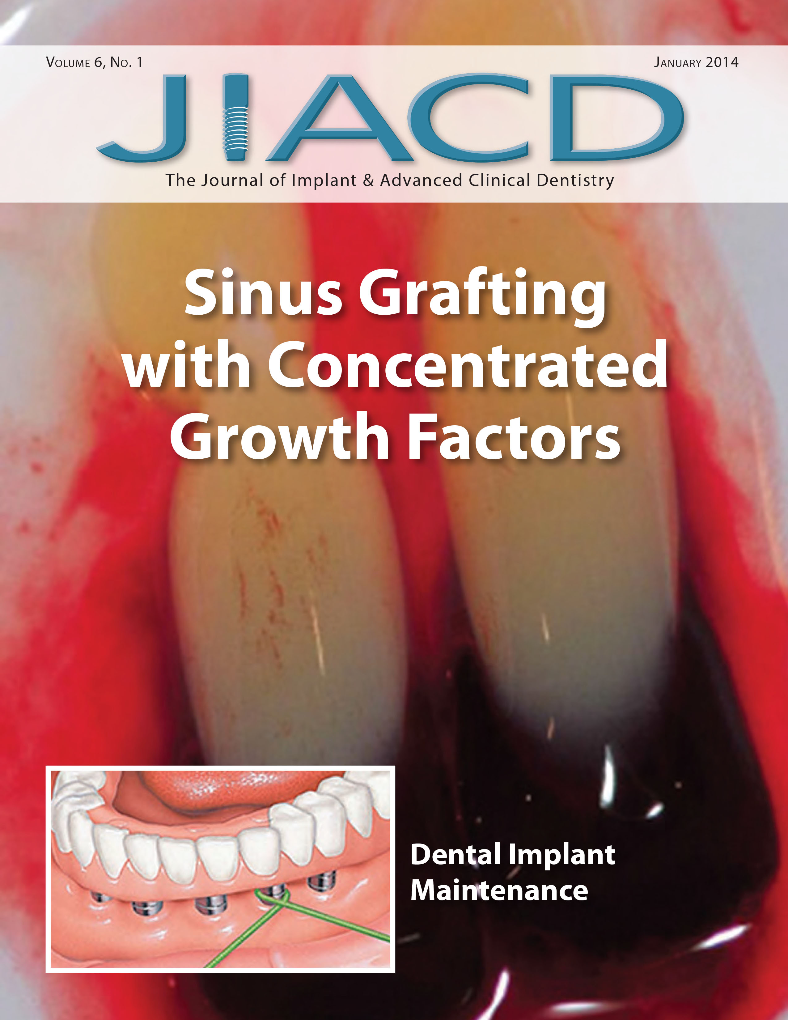 Sinus Grafting with Concentrated Growth Factors