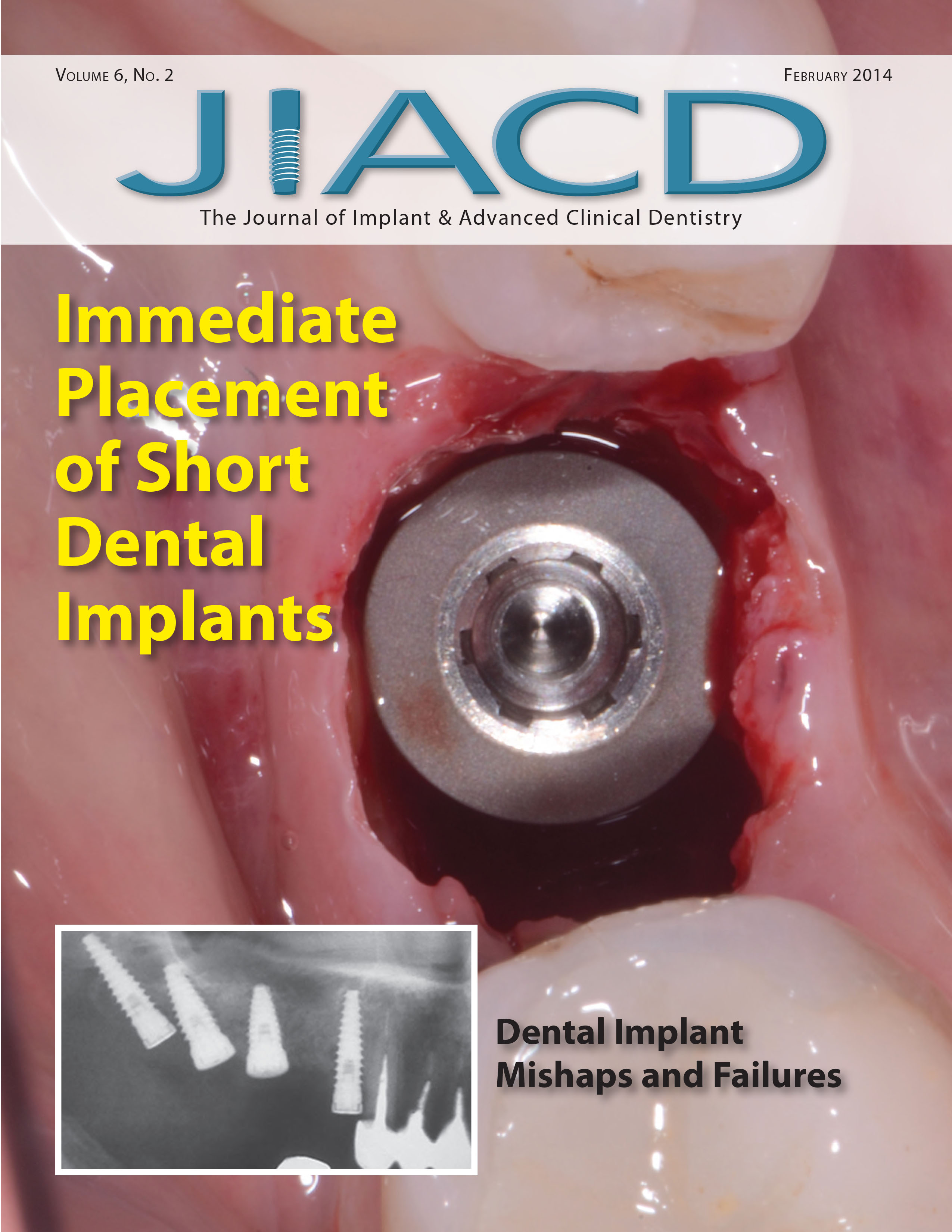 Immediate Placement of Short Dental Implants