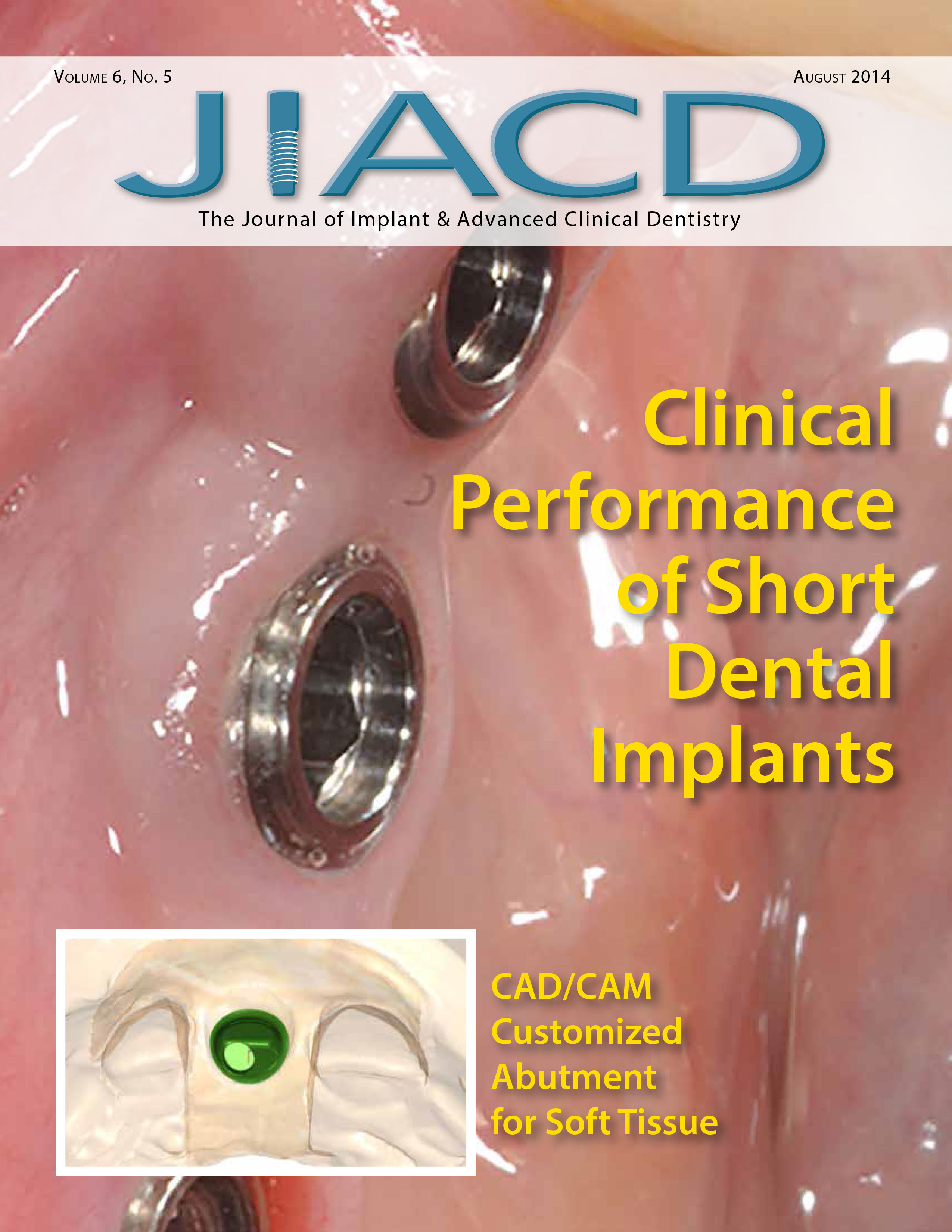 Clinical Performance of Short Dental Implants