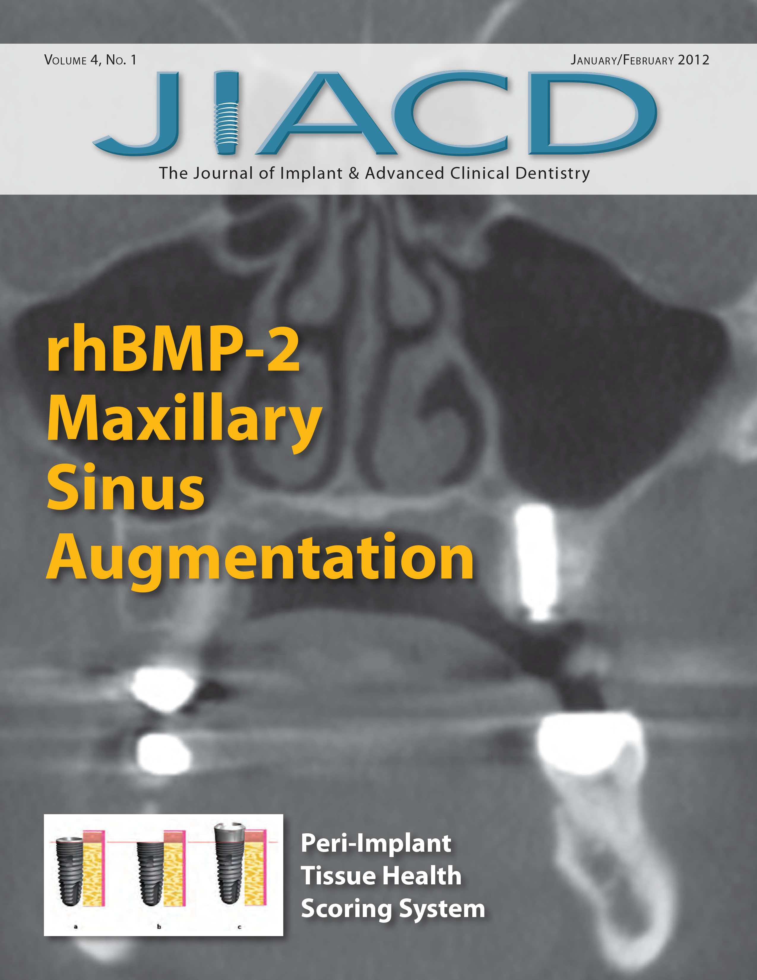 rhBMP-2 Maxillary Sinus Augmentation