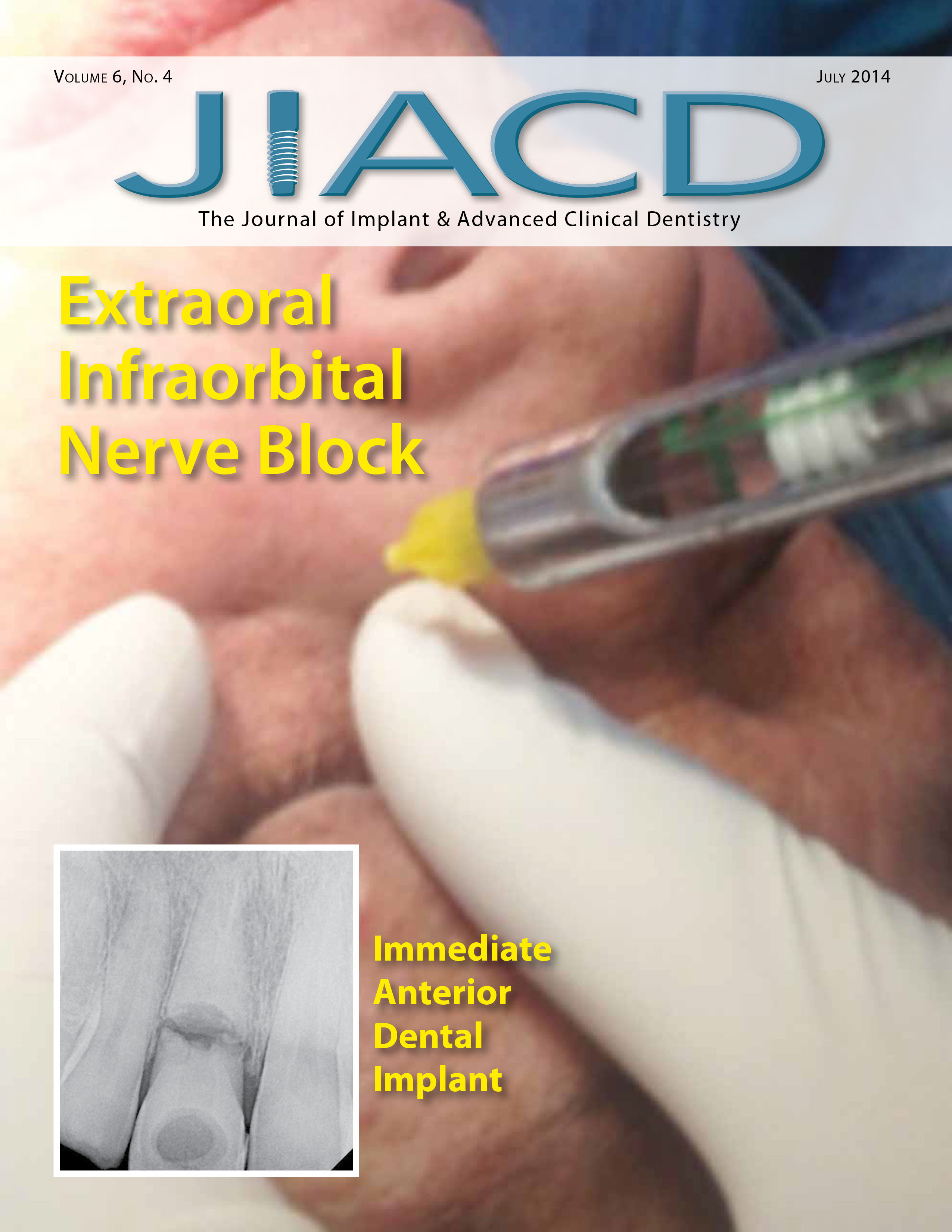 Extraoral Infraorbital Nerve Block – Immediate Anterior Dental Implant