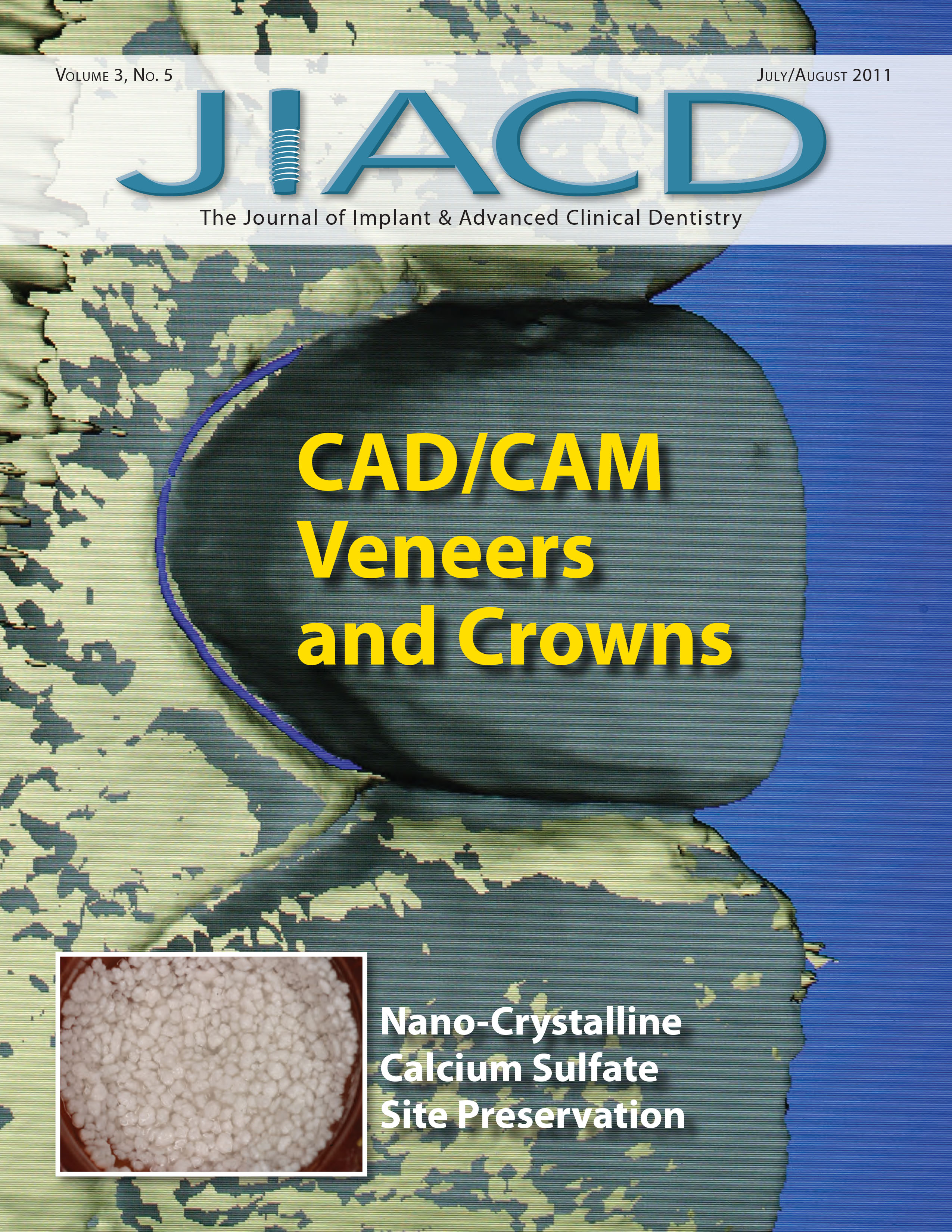 CAD/CAM Veneers and Crowns