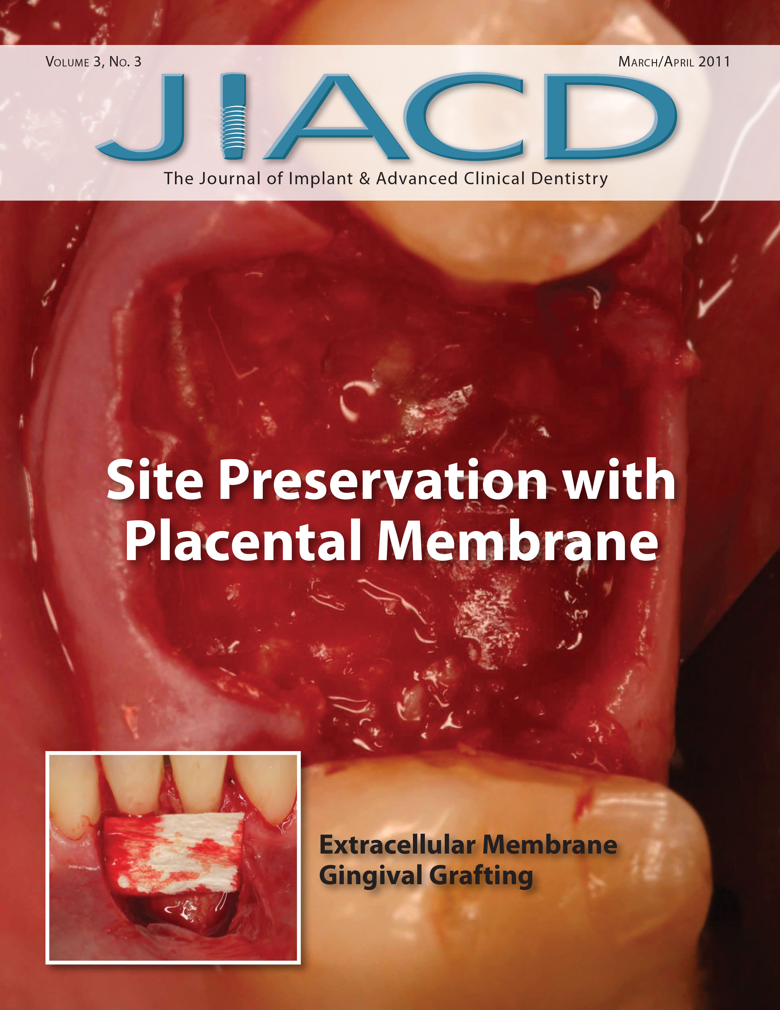 Site Preservation with Placental Membrane