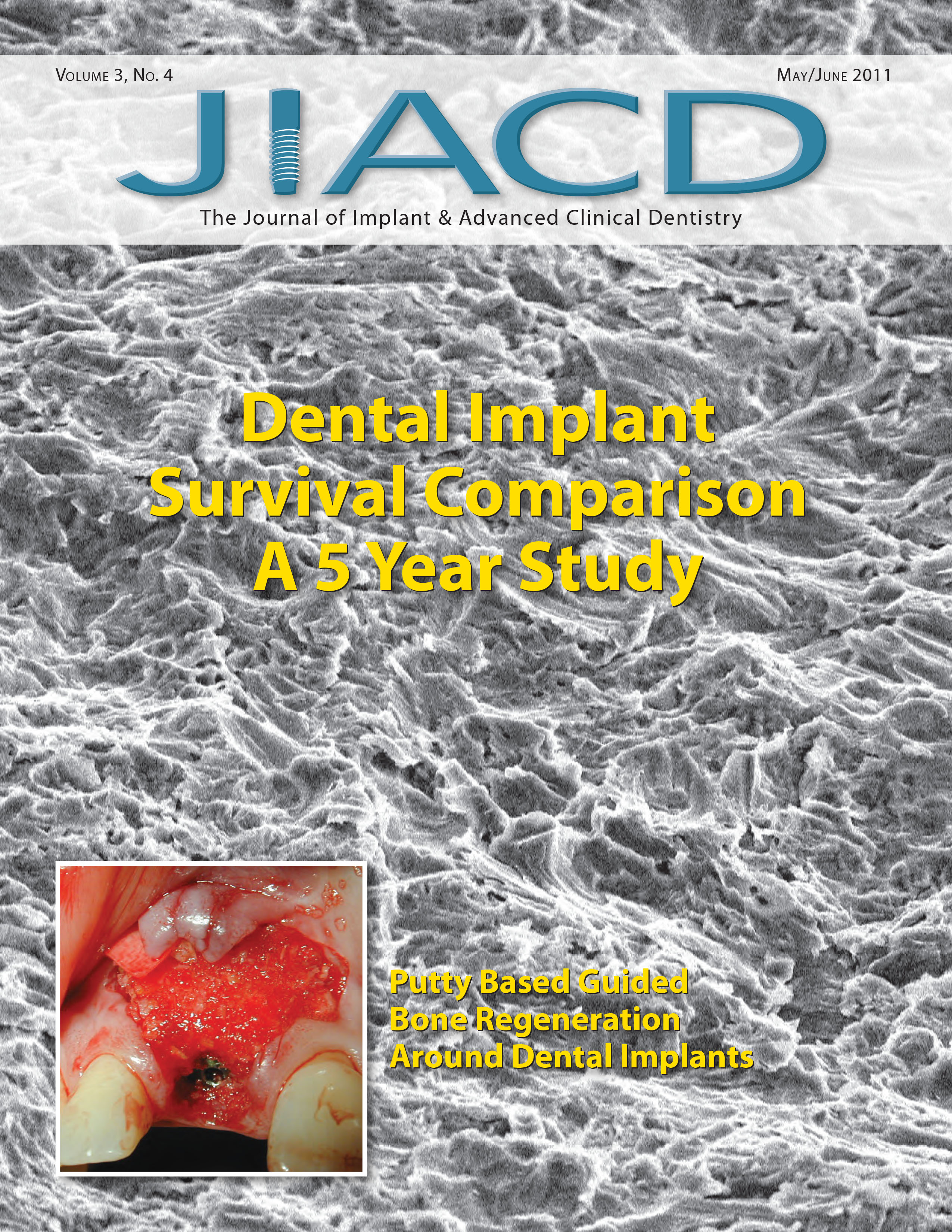 Dental Implant Survival Comparison A 5 Year Study