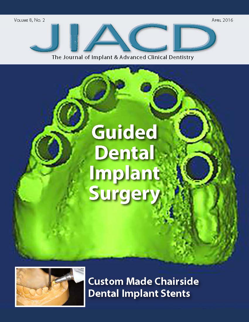Guided Dental Implant Surgery