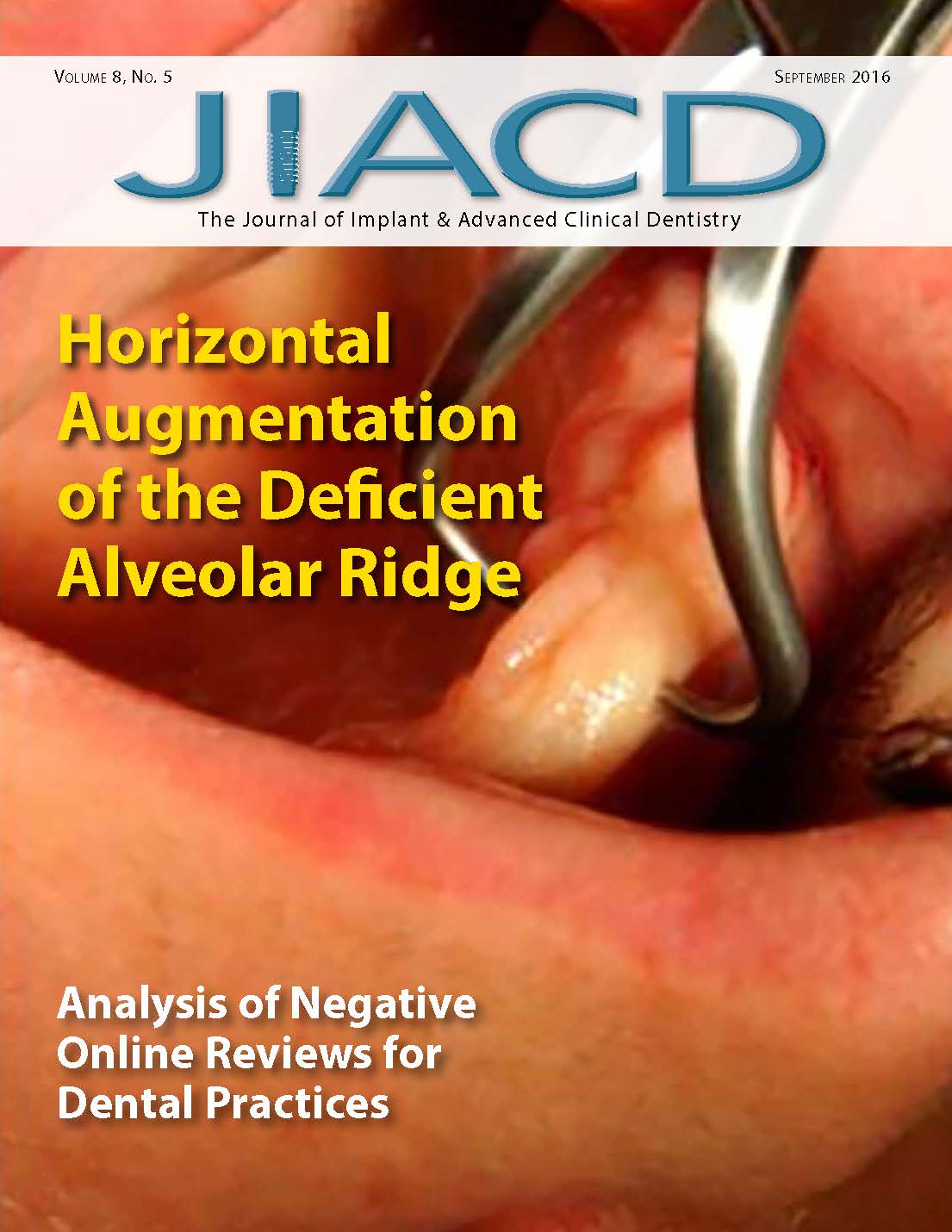 Horizontal Augmentation of the Deficient Alveolar Ridge