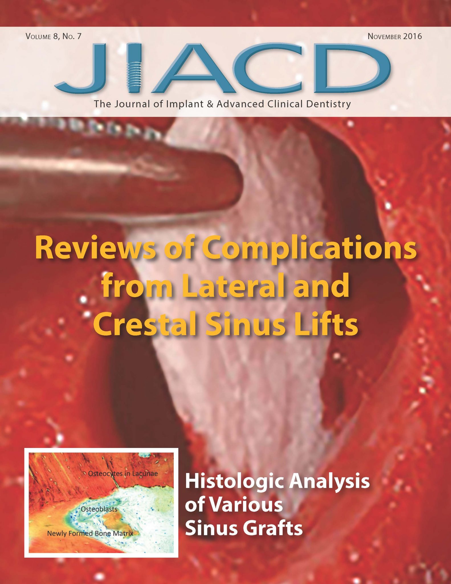 Reviews of Complications from Lateral and Crestal Sinus Lifts