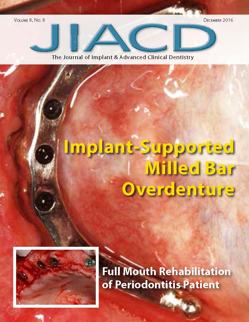 Implant-Supported Milled Bar Overdenture