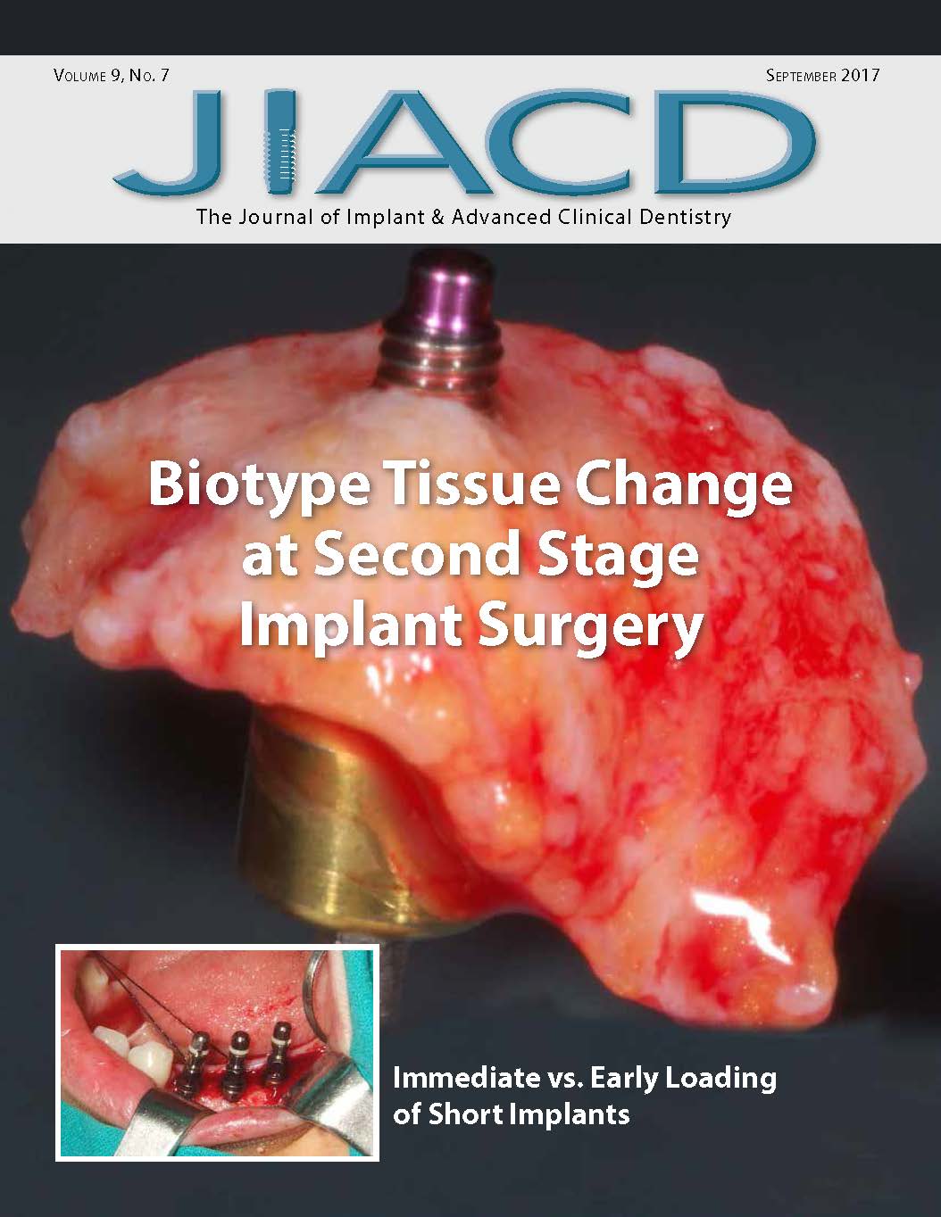 Biotype Tissue Change at Second Stage Implant Surgery