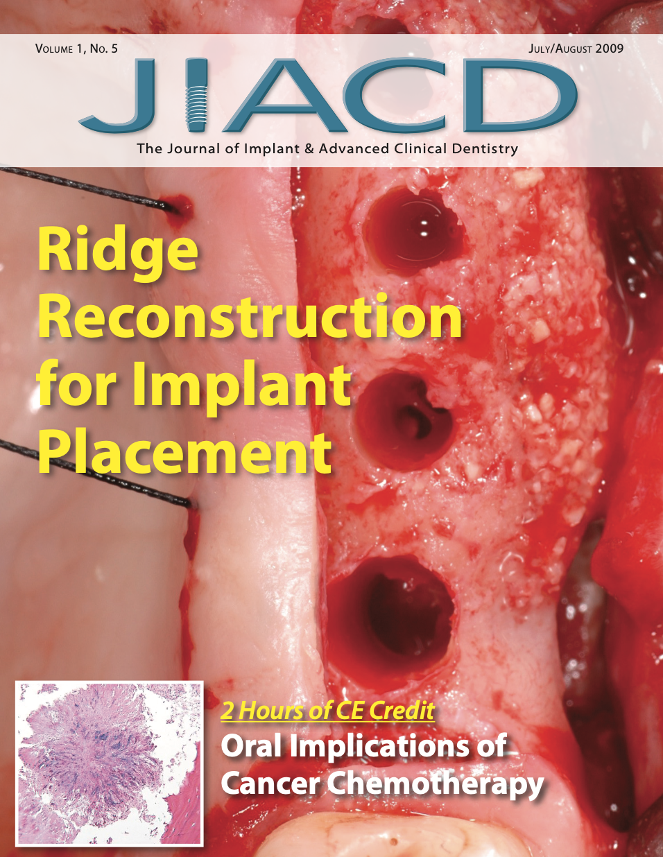 Ridge Reconstruction for Implant Placement