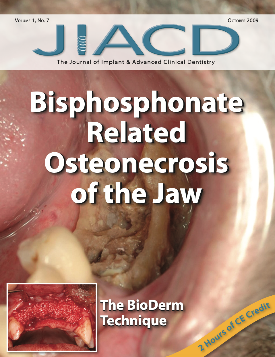 Bisphosphonate Related Osteonecrosis of the Jaw