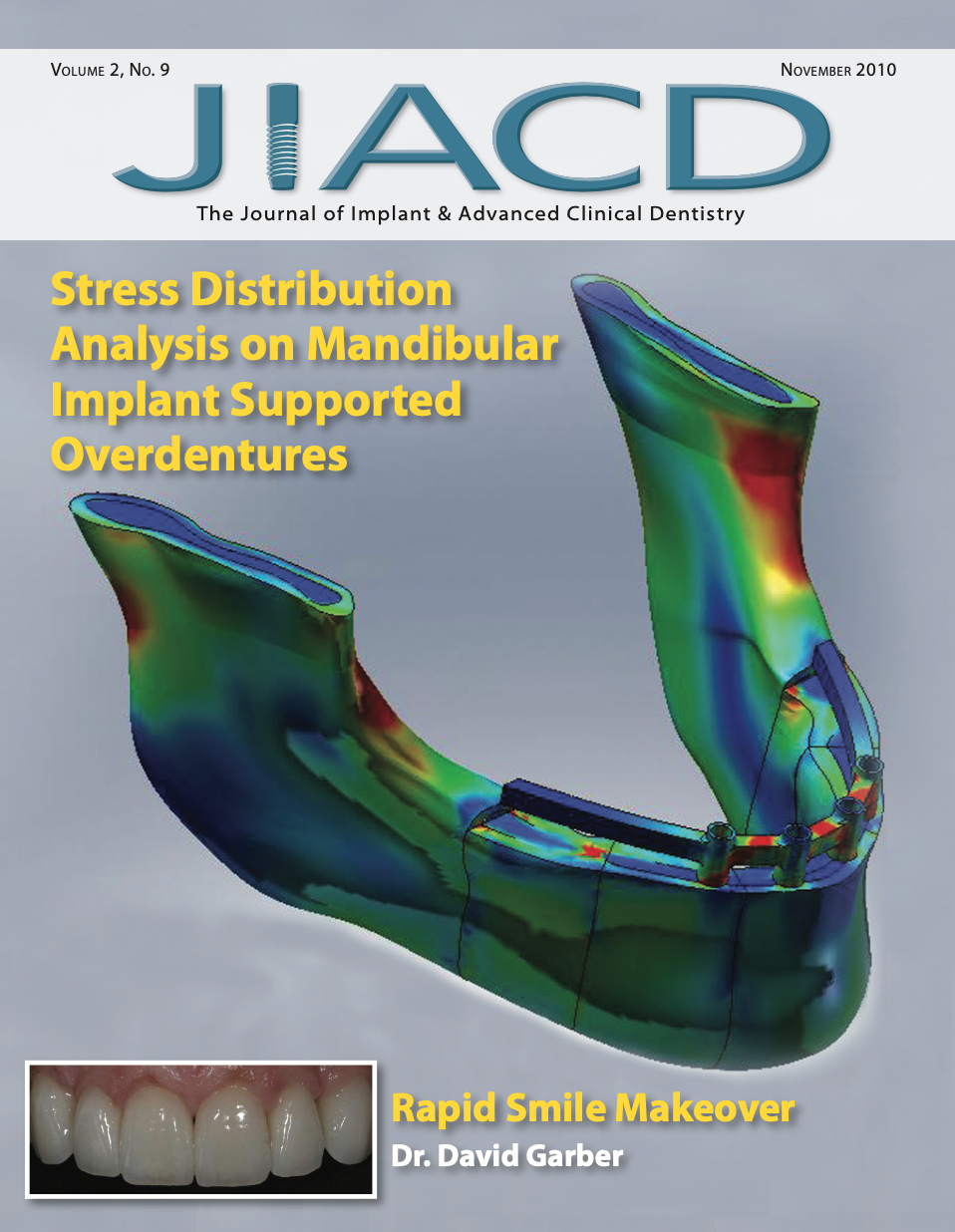 Stress Distribution Analysis on Mandibular Implant Supported Overdentures